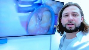 Подготовка зуба , под керамическую вкладку , кариес под пломбой ,