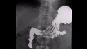 Скопия желудка с барием, хронический гастрит