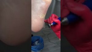 Обработка стоп Smart диском