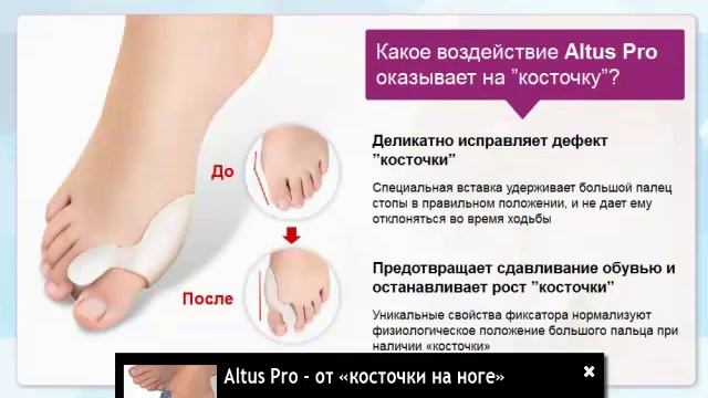 Шишки на ногах, как лечить?