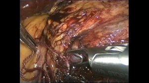 нефрэктомия слева