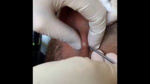 выдавливание прыщей | выдавливание чёрных точек