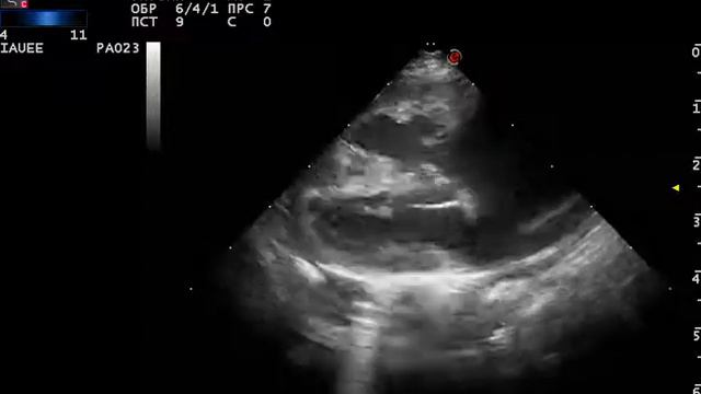 Дефект межпредсердной перегородки кот смотреть онлайн
