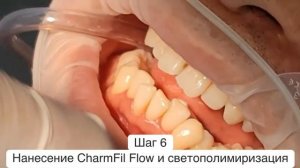 Новинка! Жидкотекучий светоотверждаемый материал для зубов Charmfil flow (Чамфил флоу).