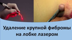 Удаление крупной фибромы на коже лобка лазером