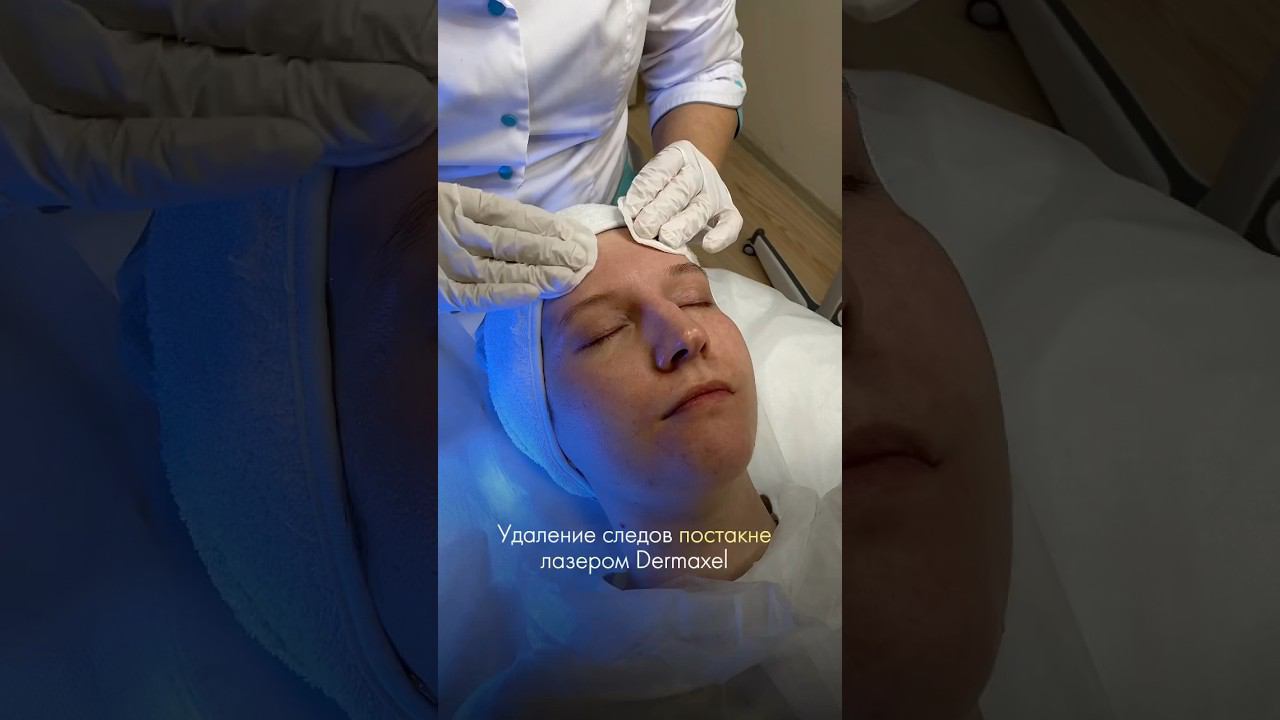Стереть постакне с лица - лазерная CO2 шлифовка Dermaxel #лазернаяшлифовка #постакне