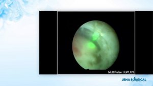 Webinar by Dr. Piesche - HoLEP EPS – Enucleation with the „Active Airbag“ Technique