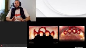 цирконевые коронки на передние зубы #стоматология #кариес #имплант #стоматолог #виниры