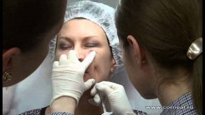 Веерная техника, канюли