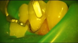 Реставрация зуба.Клиновидный дефект.Анира дентал.Новосибирск.2140252