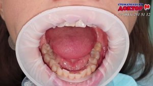 Вывих диска #внчс . Вправление диска. #Каппа. Не открывается рот