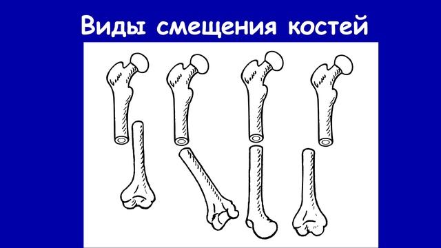 Лечение неправильно сросшихся переломов конечностей. Доктор Артемьев А.А.