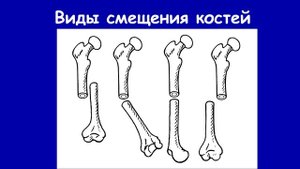 Лечение неправильно сросшихся переломов конечностей. Доктор Артемьев А.А.