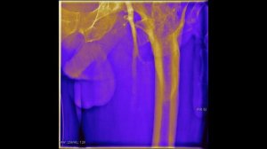 Ангиография сосудов нижних конечностей