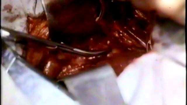 Поясничная симпатэктомия, академик М.И.Кузин © Lumbar sympathectomy