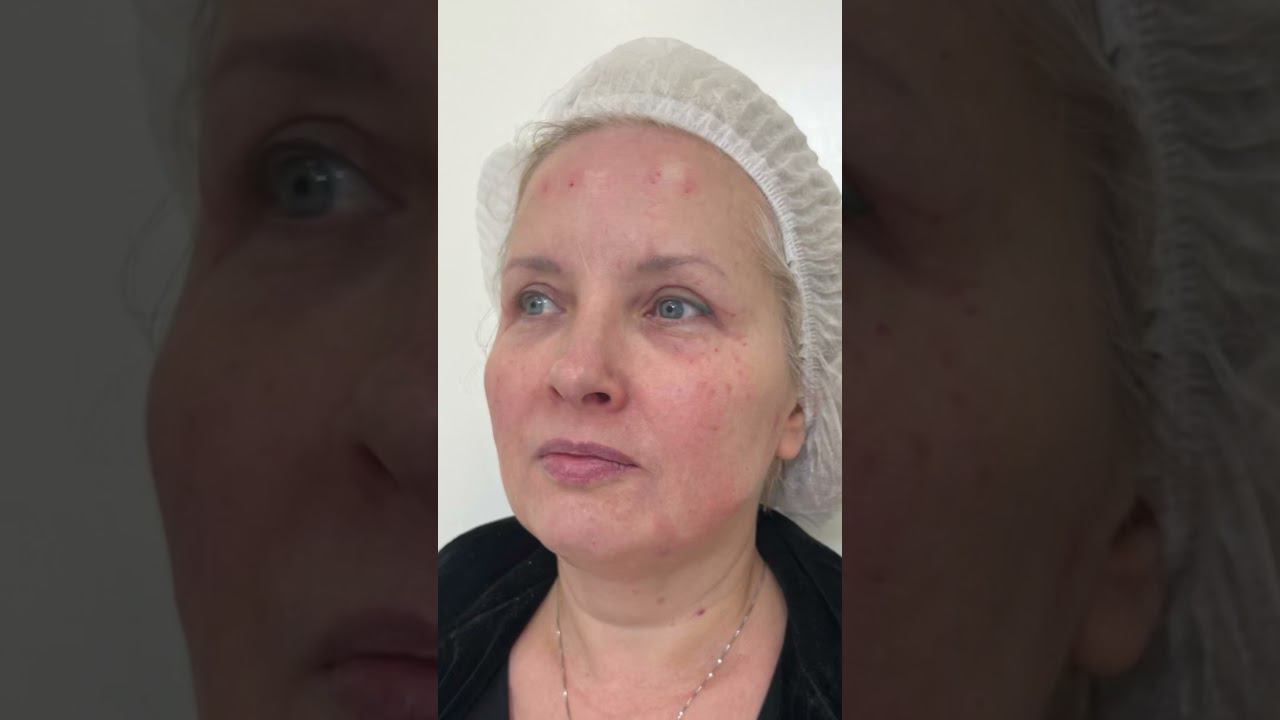 Face Lift 5+ #врачкосметолог #красивоелицо #омоложениелица #подтяжкакожи #ботокс #уколыкрасоты