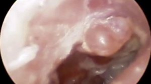 #ЛОР ВРАЧ ЛЕЧЕНИЕ ХРОНИЧЕСКОГО #ГРИБКОВОГО #ОТИТА ОТОМИКОЗ ОТОСКОПИЯ В КЛИНИКА ОБРАЗЦОВА