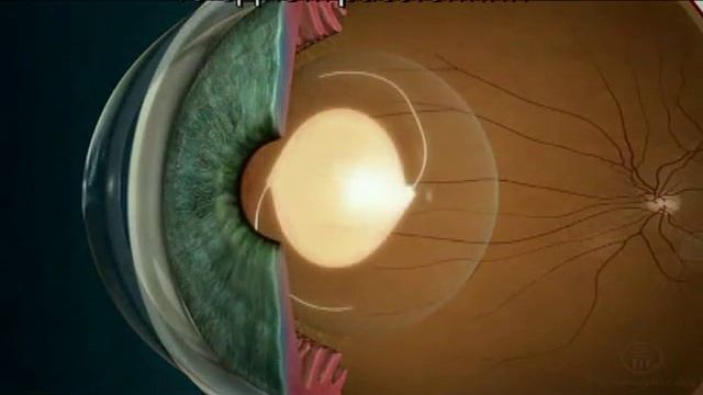 ИОЛ моно и мульти смотреть онлайн