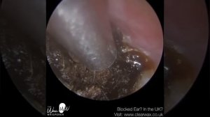 1,381 - Last Hope Ear Wax Removal for Patient in a lot of Discomfort