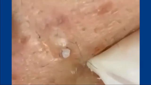 Удаление черных точек 2021-15a/ Blackheads Acne Big