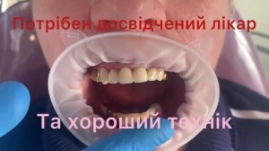 металлокерамические зубные коронки днепр клиника Брамадент. Керамика и металлокерамика.