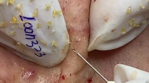 Blackheads removal (333b) | Loan Nguyen
