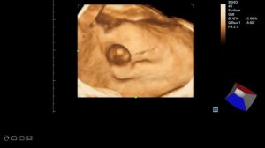 Дивертикул мочевого пузыря, УЗИ  3D/ 4D, Mindray - dc7
Vesicae urinariae, diverticulum, ultrasound