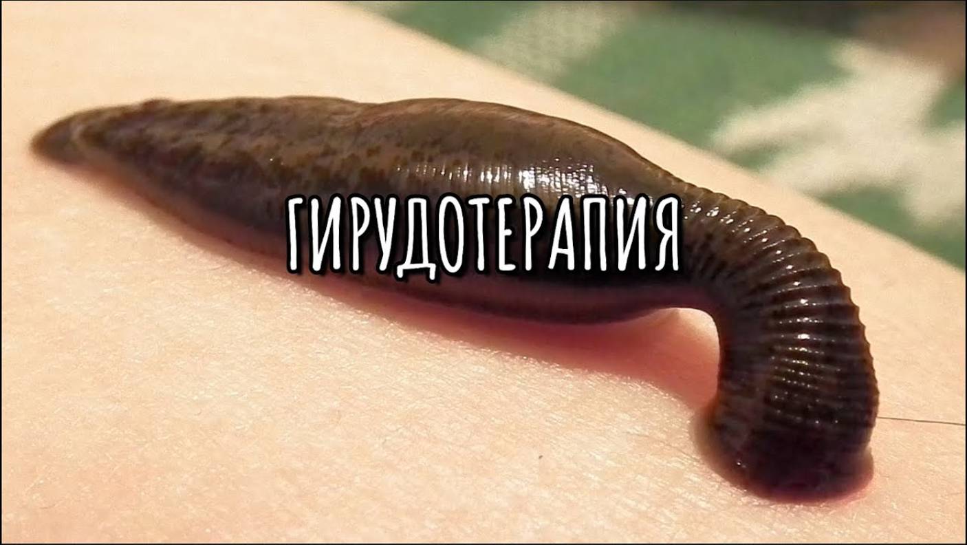 ГИРУДОТЕРАПИЯ
