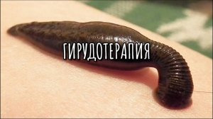ГИРУДОТЕРАПИЯ