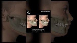 Ортогнатическая хирургия?