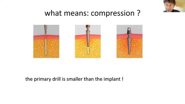 Implanturi cu incarcare imediata pentru incepatori смотреть онлайн