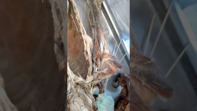 Плечевое сплетение ..plexus Brachialis