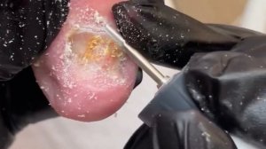 Сложная зачистка ногтей / Онихогрифоз