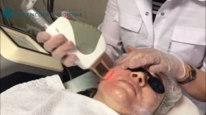 Фракционное омоложение, фототермолиз, CO2, показания, противопоказания. на аппарате MORE-XEL BISON