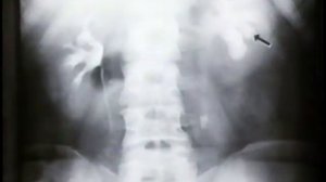 Экскреторная урография © Descending urography