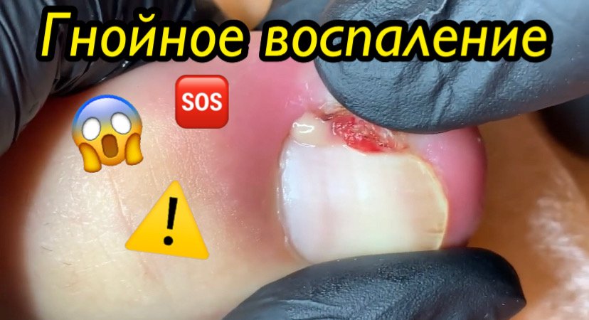 Гнойное воспаление ?⚠️????