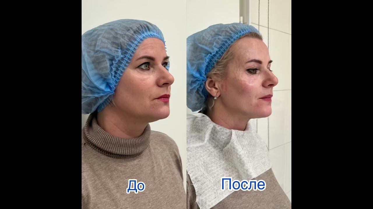Омоложения без операции. #врачкосметолог #красивоелицо #подтяжкакожи #омоложениелица #омоложениешеи