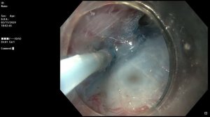 Удаление новообразования толстой кишки методом тоннельной диссекции в подслизистом слое