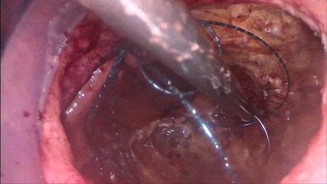 Трансанальное (TaMIS) удаление ворсинчатой аденомы прямой кишки смотреть онлайн