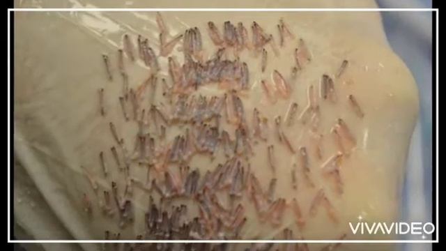 Saç ekimi DHI смотреть онлайн