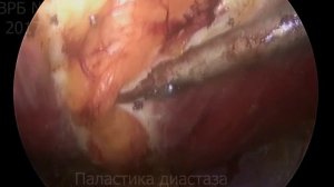 Диастаз прямых мышц и пупочная грыжа