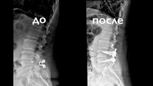 Замена сломавшегося межостистого импланта на позвоночнике транспедикулярной системой