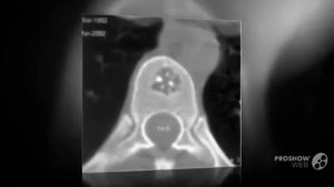 Гемангиома позвоночника гемангиома в позвонке