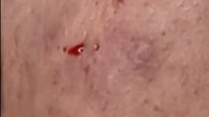 Part 66 : Blackhead Removal Complete Video by Dr. Nana Blackhead Removal