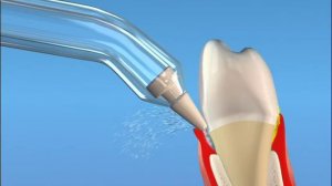 Пародонтологическая насадка для ирригатора Omiotton PP-350