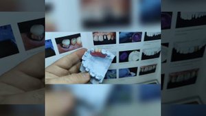 Протез бабочка ?этапы изготовления