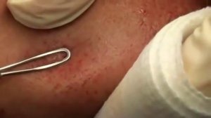 Правильное выдавливание прыщей, угрей видео