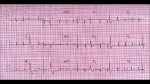 ЭКГ номер 1 - заключение, клиническая интерпретация и что делать
