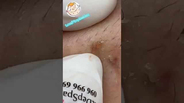 #черныеточки #чисткалица #прыщи