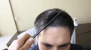 Результат пересадки 1600 графтов волос мужчине на голову